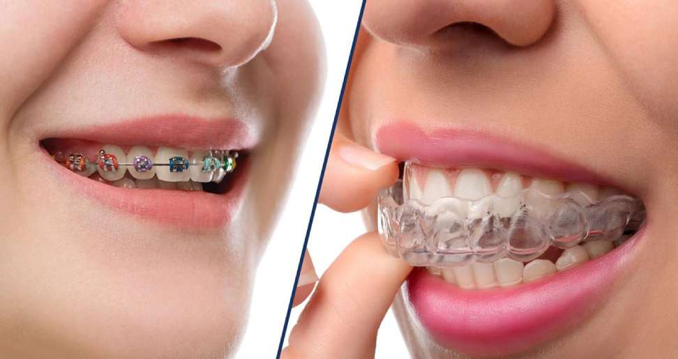 Invisalign vs Dental Braces: